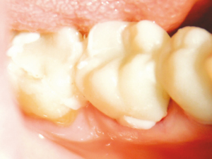 SEAL-TEMP-3-Cementation-of-the-temporary-bridge