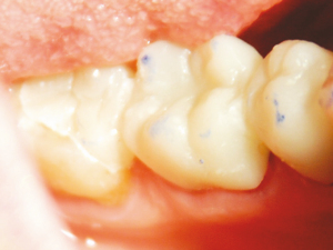 SEAL-TEMP-4-Temporary-bridge-trimmed-cemented-occlusion-checked