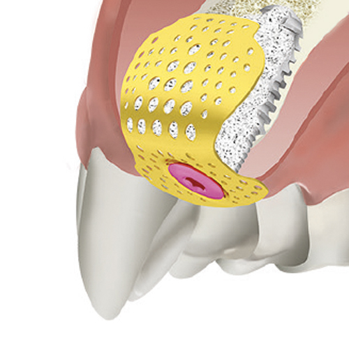 Bionika Titanium Membrane 3